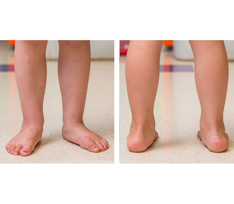 alteraciones-marcha-3