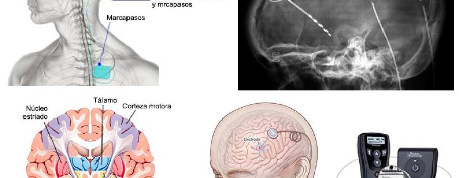 estimulador-cerebral.jpg