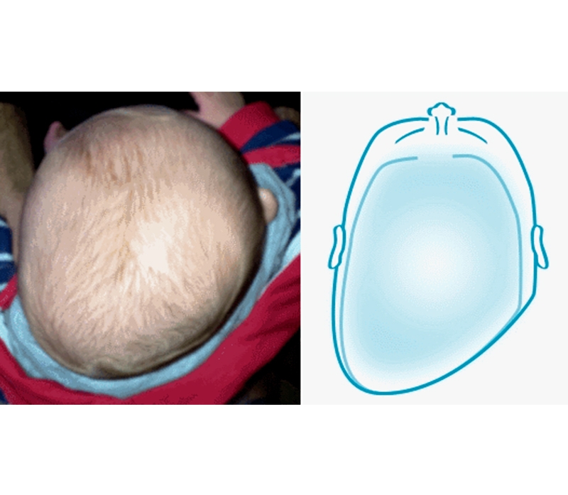 plagiocefalia-2
